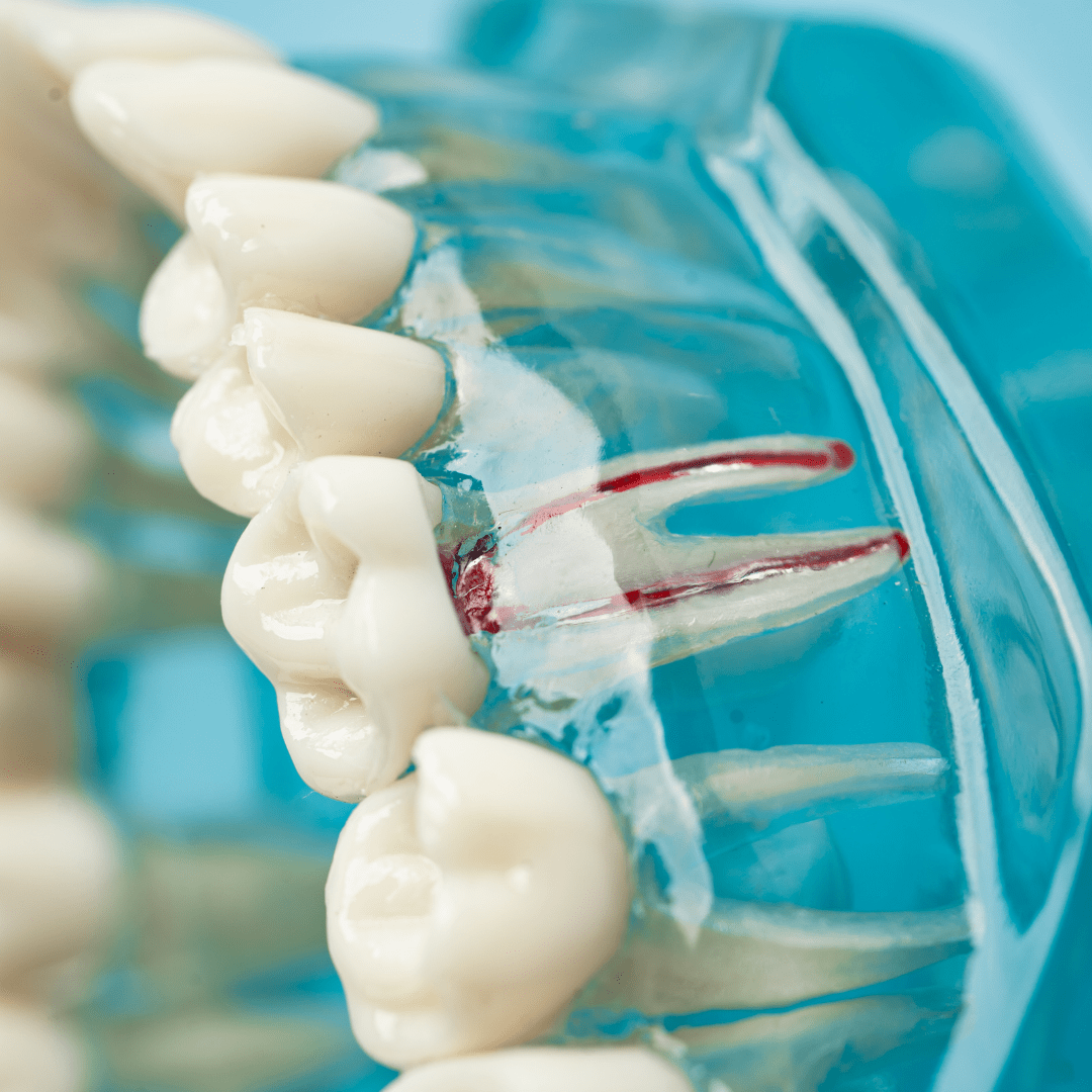 Root Canal Treatment