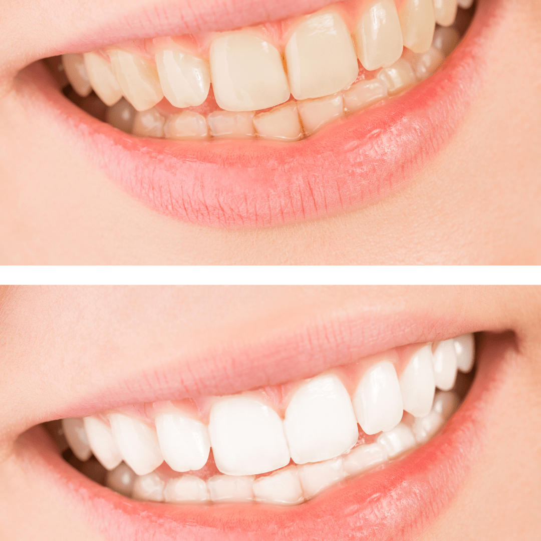 Teeth Whitening